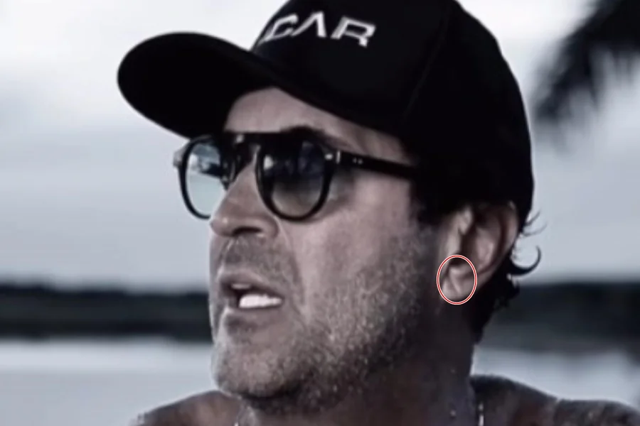 Sinal de Frank pode indicar risco de infarto? Cardiologista explica