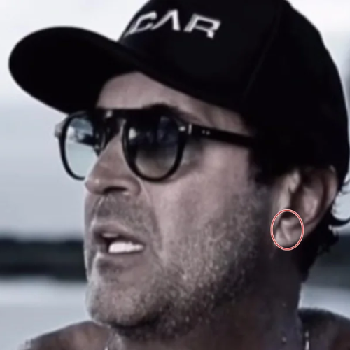 Sinal de Frank pode indicar risco de infarto? Cardiologista explica