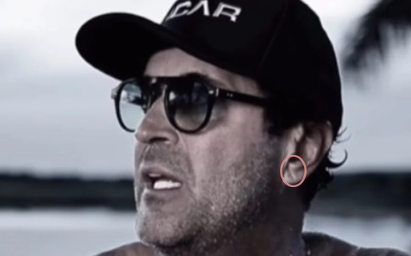 Sinal de Frank pode indicar risco de infarto? Cardiologista explica